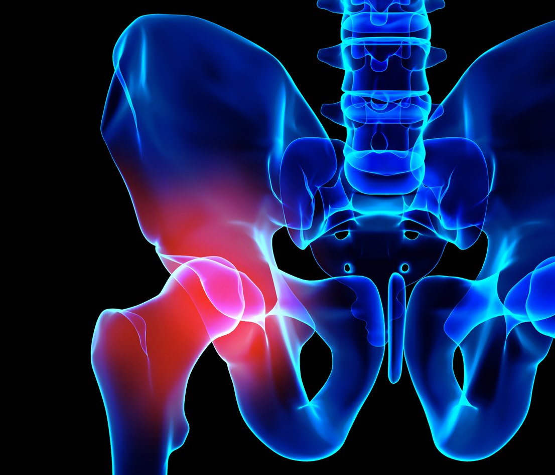 groin pain after hip replacement