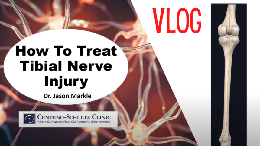 tibial nerve injury presentation by Dr. Markle of Centeno-Schultz Clinic