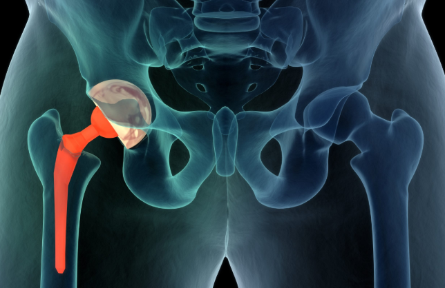 hip replacement failure blog banner